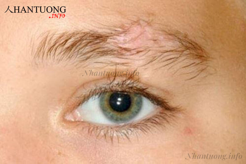 Lông mày đứt đoạn Lông mày đứt đoạn