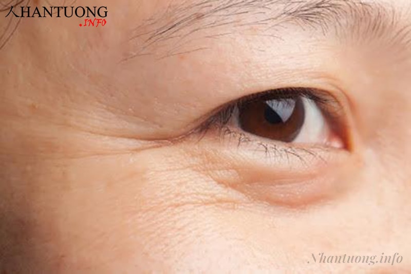 Đuôi mắt có nếp nhăn ngang Đuôi mắt có nếp nhăn ngang