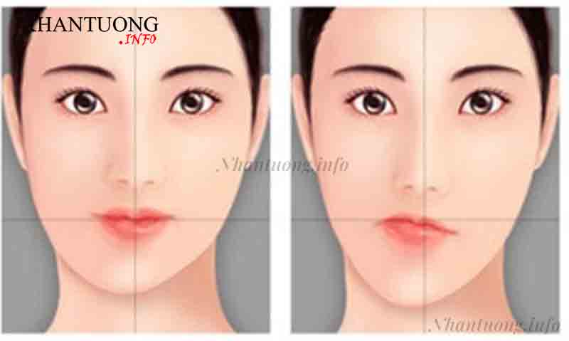 Miệng lệch, không cân xứng Miệng lệch, không cân xứng