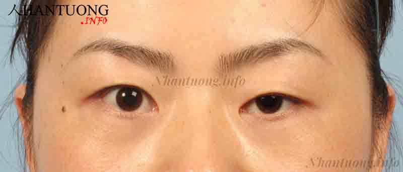 2 mắt không đều, mắt trái lớn hơn mắt phải 2 mắt không đều, mắt trái lớn hơn mắt phải