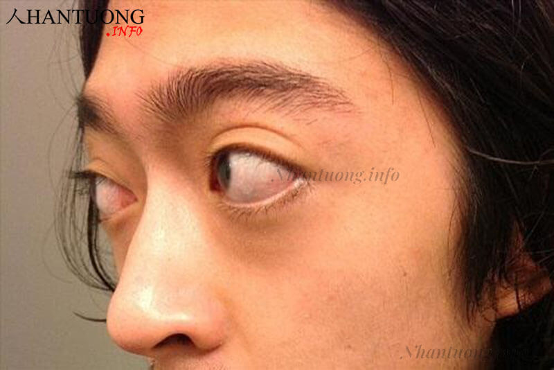 Con ngươi lồi ra Con ngươi lồi ra