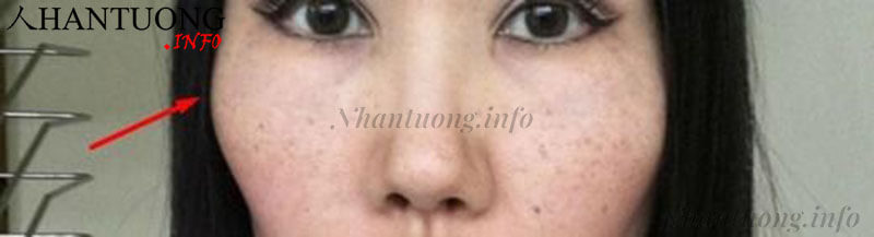Gò má cao, nhọn Gò má cao, nhọn