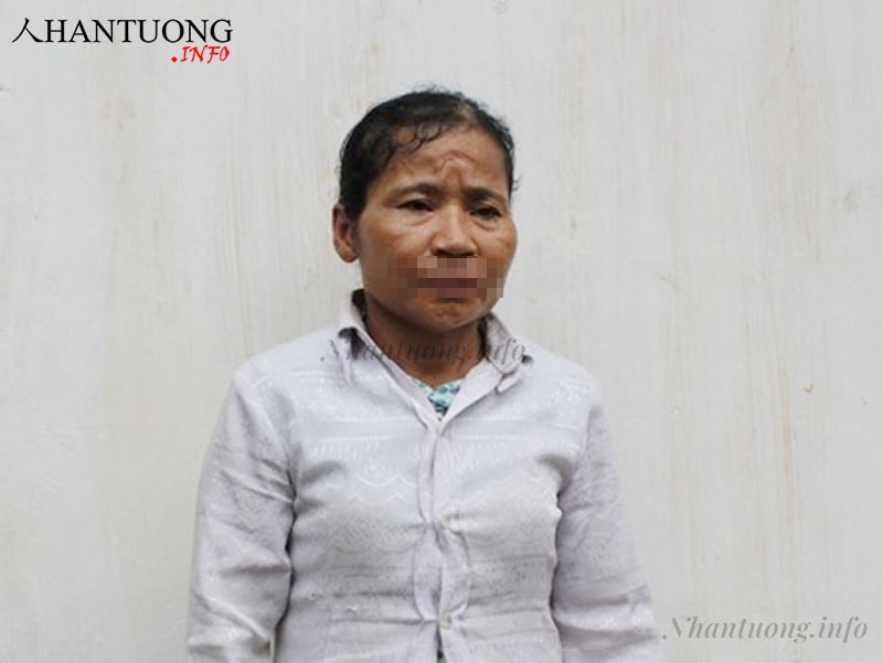 Đối tượng N.T. L giết chồng 4/2014 trên trán có sẹo, xương mày thô cứng, cung phu thê hõm Đối tượng N.T. L giết chồng 4/2014 trên trán có sẹo, xương mày thô cứng, cung phu thê hõm