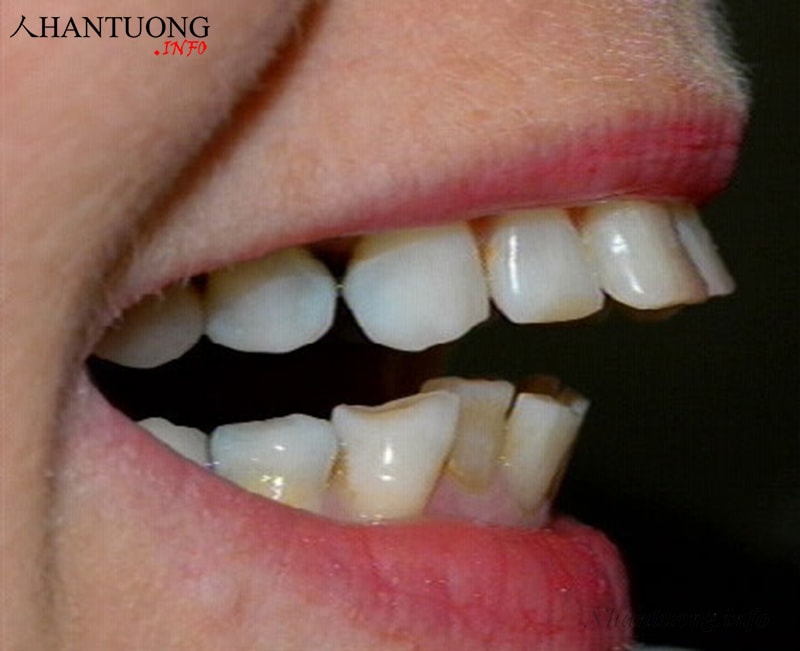 Người có tướng môi hở răng thường bị hô hoặc móm nặng Người có tướng môi hở răng thường bị hô hoặc móm nặng