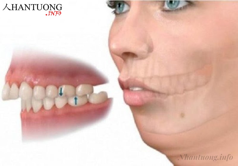 Tướng miệng vẩu Tướng miệng vẩu