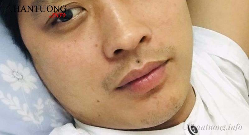 Nốt ruồi ở nhân trung ở nam giới Nốt ruồi ở nhân trung ở nam giới