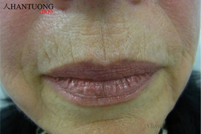 Tướng nhân trung hẹp như sợi chỉ Tướng nhân trung hẹp như sợi chỉ