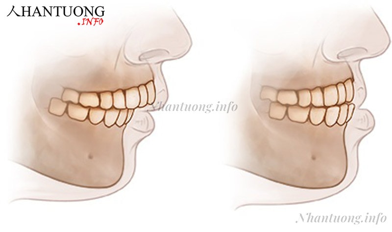 Hình dáng khuôn miệng móm Hình dáng khuôn miệng móm