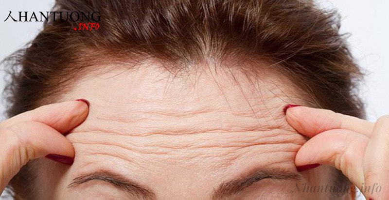 Trán nhiều nếp nhăn ngang đứt quãng Trán nhiều nếp nhăn ngang đứt quãng