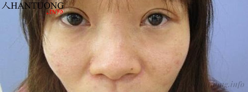 Nhận diện người có tướng gò má cao mũi tẹt Nhận diện người có tướng gò má cao mũi tẹt