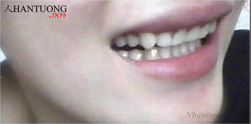 Người có tướng hàm răng dưới hướng vào trong Người có tướng hàm răng dưới hướng vào trong