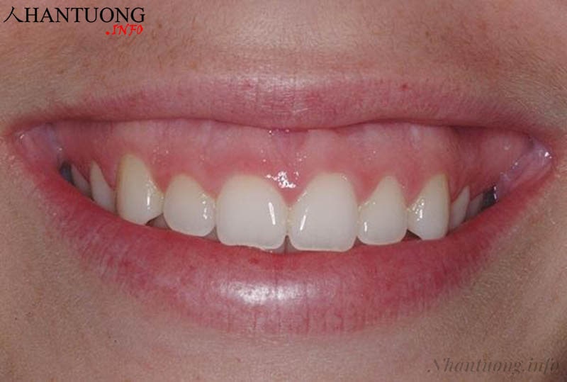 Tướng người cười hở lợi Tướng người cười hở lợi