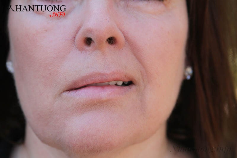 Người mang tướng miệng lệch Người mang tướng miệng lệch