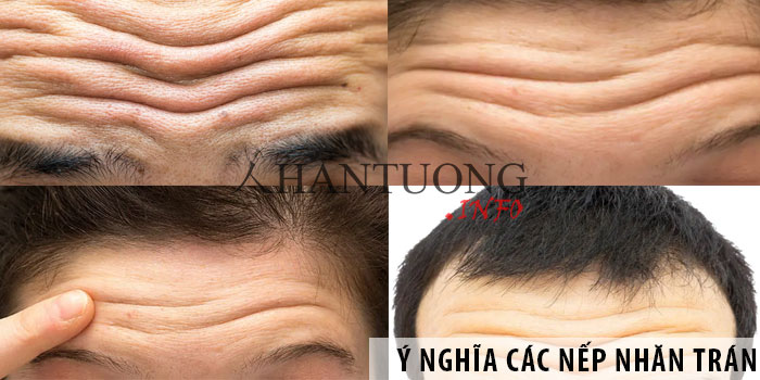 Đàn ông, phụ nữ trên trán có nhiều nếp nhăn ngang thì sao? 1 Nếp nhăn trên trán có ý nghĩa gì