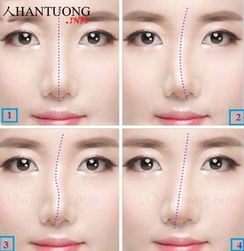 Các tướng mũi lệch, cong vẹo thường thấy Các tướng mũi lệch, cong vẹo thường thấy