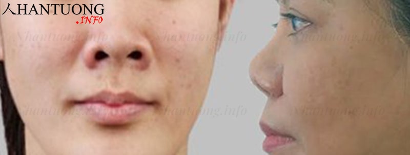 Hình ảnh thực tế của tướng mũi hếch, mũi hình, tướng mũi ba ba Hình ảnh thực tế của tướng mũi hếch, mũi hình, tướng mũi ba ba