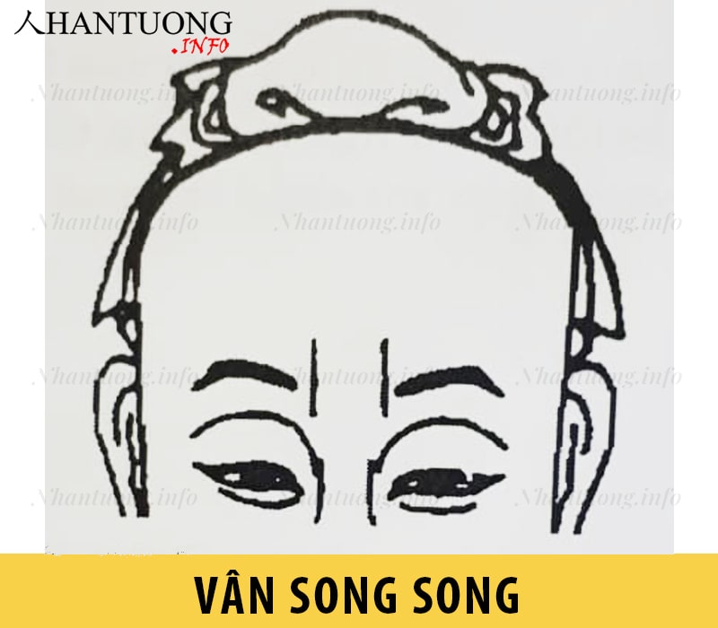 Vân song song - hai nếp nhăn song song ở ấn đường Vân song song - hai nếp nhăn song song ở ấn đường