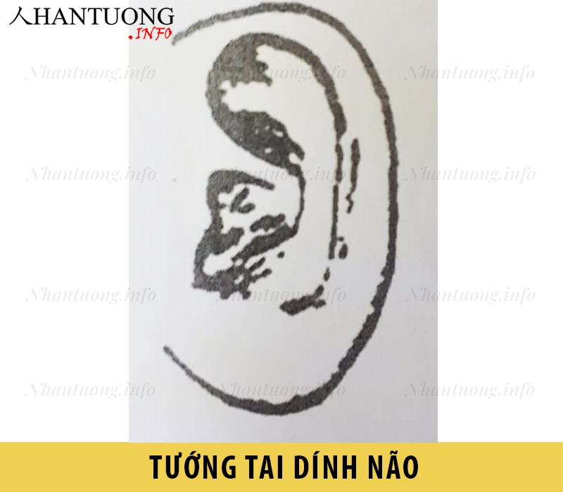 Hình dáng tướng tai dính não Hình dáng tướng tai dính não