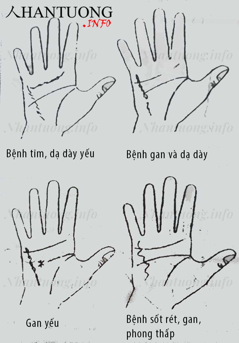 Xem đường thủy tinh đoán biết bệnh tật 3 Xem đường thủy tinh đoán biết bệnh tật 3