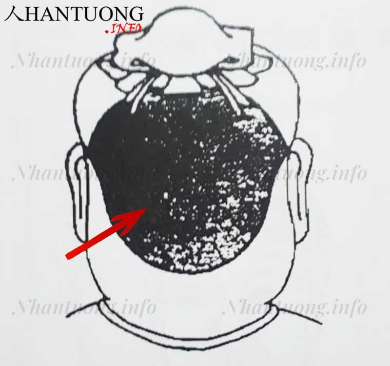 Vị trí xương chẩm trên đầu Vị trí xương chẩm trên đầu