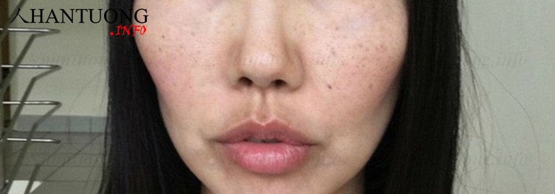 Tướng má hóp rất nhiều so với mặt Tướng má hóp rất nhiều so với mặt