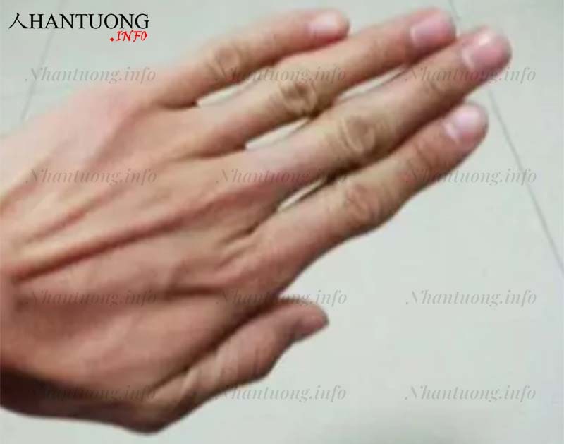 Khe hở giữa các ngón rộng Khe hở giữa các ngón rộng