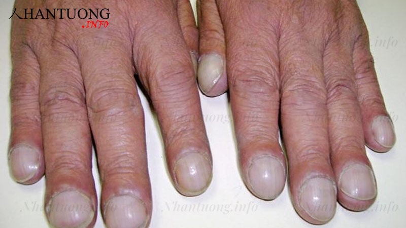 Móng tay hippocrate - ngón tay dùi trống thường thấy ở người bệnh tim, phổi Móng tay hippocrate - ngón tay dùi trống thường thấy ở người bệnh tim, phổi