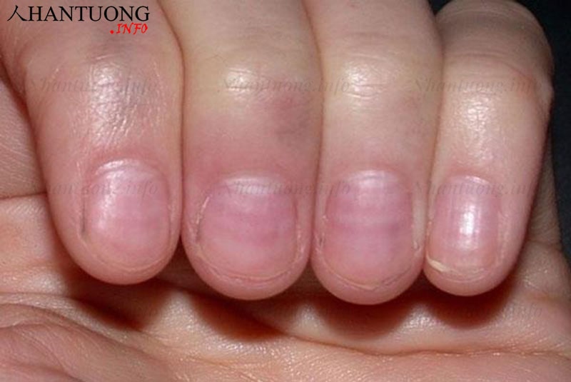 Đường beau - dấu hiệu mắc bệnh cấp phát và bệnh ngoại thương Đường beau - dấu hiệu mắc bệnh cấp phát và bệnh ngoại thương