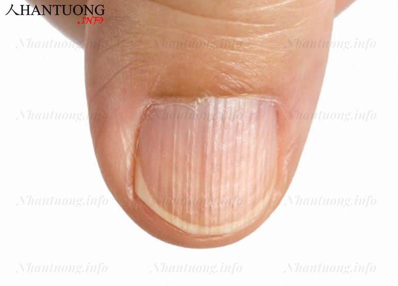 Móng tay của người đau ruột và bị phong thấp Móng tay của người đau ruột và bị phong thấp