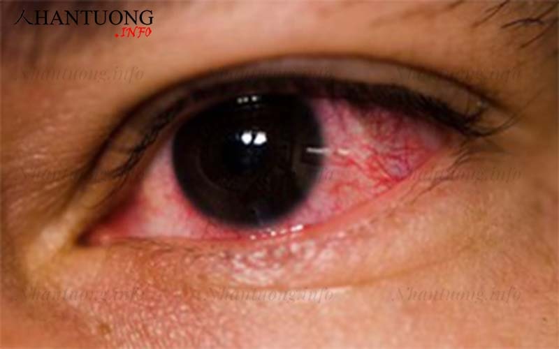 Tướng mắt đỏ như cá chày Tướng mắt đỏ như cá chày