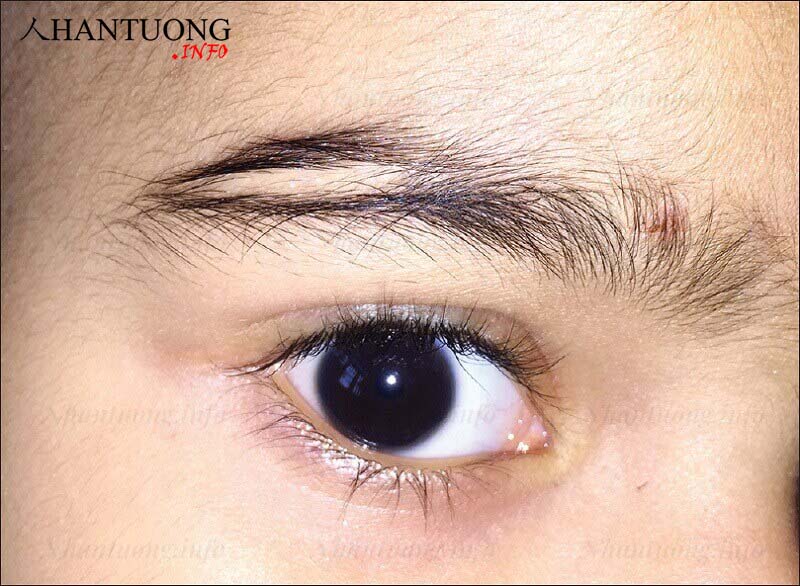 Tướng lông mày bị đứt đoạn Tướng lông mày bị đứt đoạn