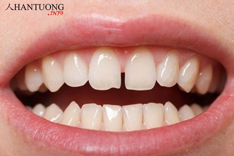 Tướng răng cửa hở Tướng răng cửa hở