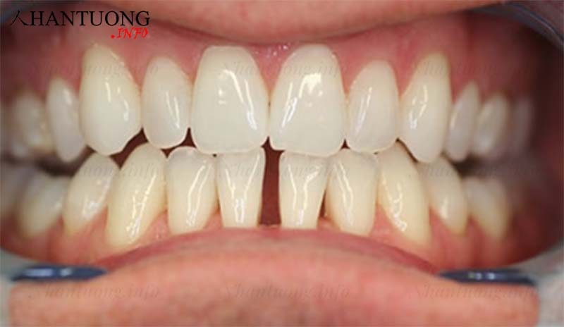 Tướng răng thưa hàm dưới Tướng răng thưa hàm dưới