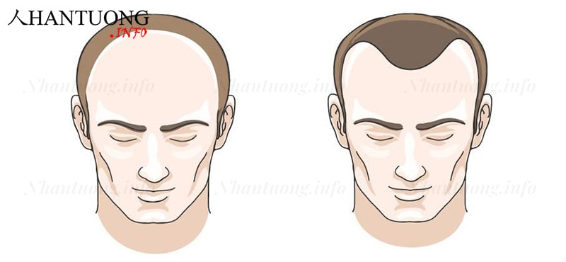 Hai dạng hói đầu thường gặp Hai dạng hói đầu thường gặp