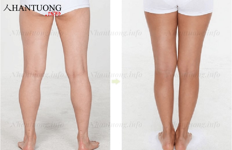 Tướng cẳng chân Tướng cẳng chân