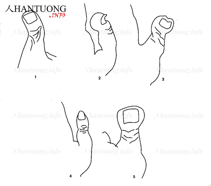 Ngón cái cong vẹo Ngón cái cong vẹo