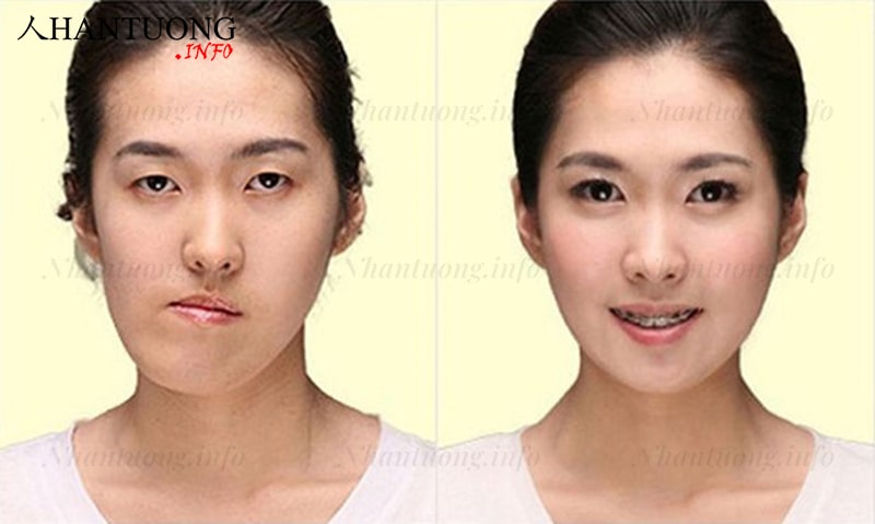 Tướng cằm lệch làm mất đi sự hài hoài trên khuôn mặt Tướng cằm lệch làm mất đi sự hài hoài trên khuôn mặt