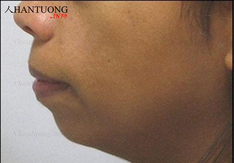 Hình ảnh tướng cằm lẹm, cằm vát Hình ảnh tướng cằm lẹm, cằm vát