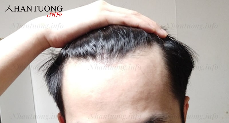 Trán rộng có chiều rộng lớn hơn mức trung bình Trán rộng có chiều rộng lớn hơn mức trung bình