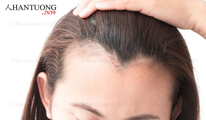 Tướng trán chữ M ở phụ nữ Tướng trán chữ M ở phụ nữ