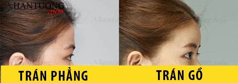 Cách nhận biết tướng trán phẳng Cách nhận biết tướng trán phẳng